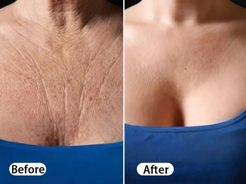 Skin firming result