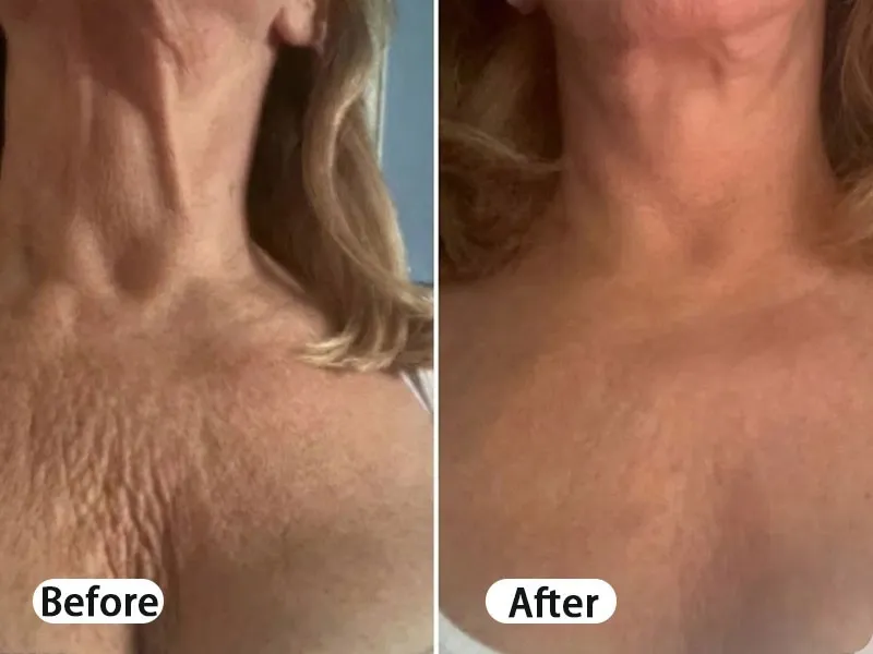 Before — skin lifting